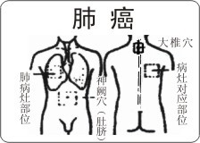 肺癌中医治疗