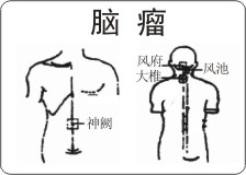 脑瘤治疗药物